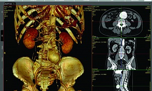 Преимущества 3D технологий  при Компьютерной Томографии сосудов и мягких тканей