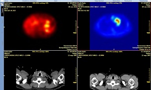 ПЭТ/КТ или ОФЭКТ? Что лучше?