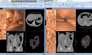 3D- реконструкция при исследовании пищеварительной системы: (Виртуальная гастро; колоноскопия) 